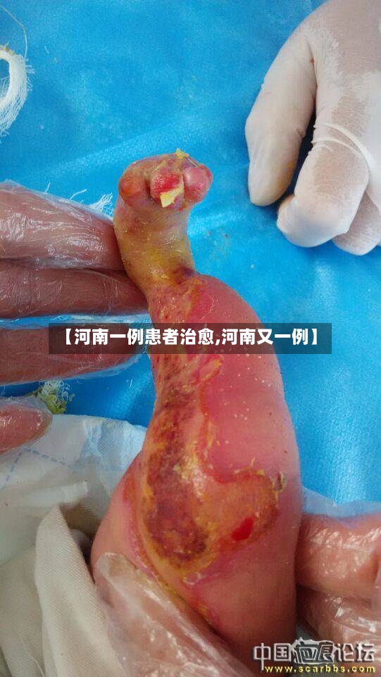 【河南一例患者治愈,河南又一例】-第2张图片