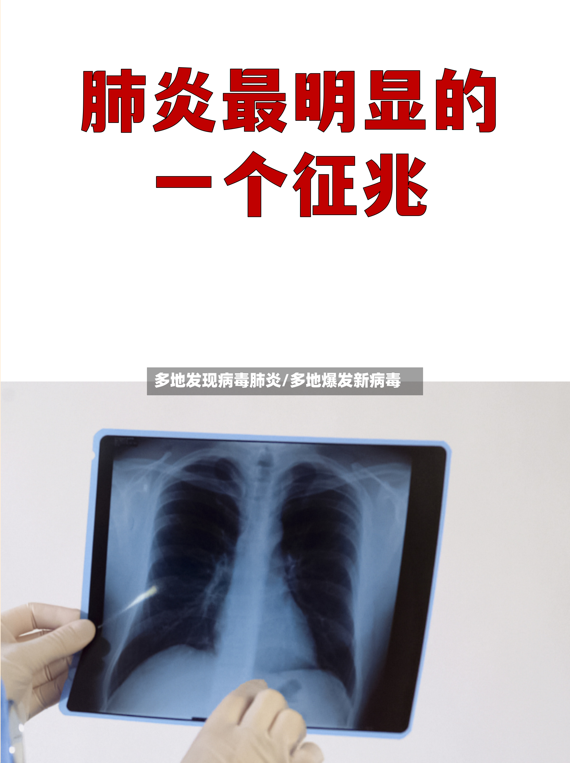 多地发现病毒肺炎/多地爆发新病毒-第2张图片